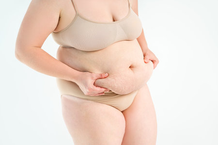 Tummy tuck, flabby skin with stretch marks on a fat belly, plastic surgery concept on gray studio backgroundの写真素材