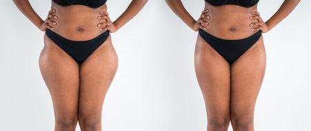 Tummy tuck, fat body before and after weight loss and liposuction on gray studio background, black African woman, plastic surgery conceptの写真素材
