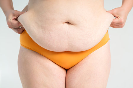 Tummy tuck, flabby skin with stretch marks on a fat belly, plastic surgery concept on gray studio backgroundの写真素材