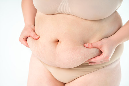 Tummy tuck, flabby skin with stretch marks on a fat belly, plastic surgery concept on gray studio backgroundの写真素材