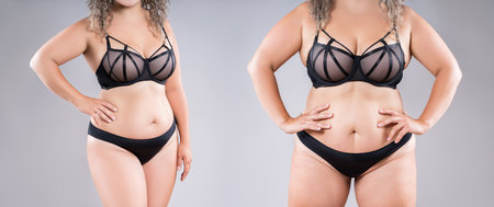 Woman's fat body in black lingerie before and after weight loss on gray studio background, tummy tuck, liposuction and plastic surgery conceptの写真素材