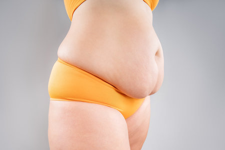 Tummy tuck, flabby skin on a fat belly, abdomen with obesity and cellulite, saggy stomach, plastic surgery concept on gray studio backgroundの写真素材