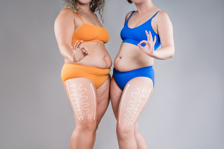 Two overweight women with cellulitis show ok, fat flabby bellies, legs, hands, hips and buttocks on gray studio background, obese female body, liposuction and plastic surgery conceptの写真素材