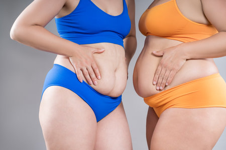 Tummy tuck, two fat women with cellulitis and flabby bellies on gray studio background, obese female body, plastic surgery and liposuction conceptの写真素材