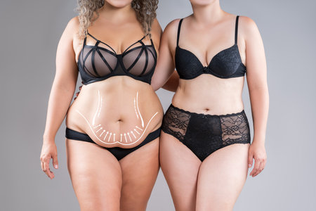 Tummy tuck, two overweight fat women with cellulitis and flabby bellies on gray studio background, obese female body, liposuction and plastic surgery concept with surgical lines and arrowsの写真素材