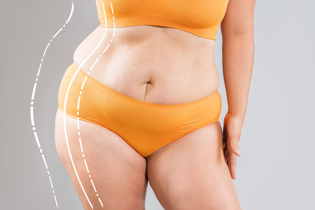 Fat woman with cellulitis, flabby belly, obesity hips and buttocks on gray studio background, obese female body, liposuction, plastic surgery and body positive concept with surgical linesの写真素材