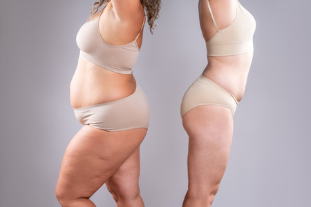 Two overweight women with cellulitis, fat flabby bellies, legs, hands, hips and buttocks on gray studio background, obese female body, liposuction and plastic surgery conceptの写真素材