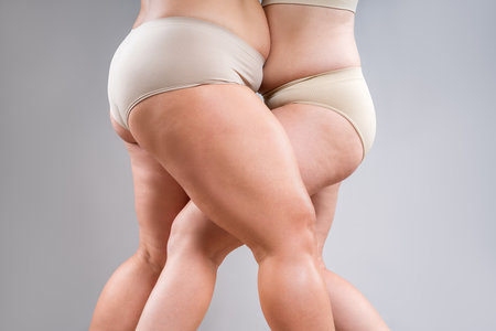 Overweight thighs, two women with fat hips, legs and buttocks, obesity female body with cellulite on gray studio backgroundの写真素材