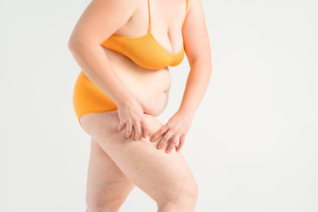 Overweight woman, fat legs with varicose veins and stretch marks, obesity female body with cellulite on gray studio backgroundの写真素材
