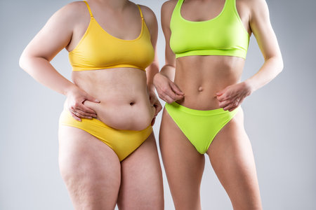 Before after weight loss, tummy tuck, fat and thin women with flabby and muscular bellies on gray studio background, plastic surgery and body positive conceptの写真素材