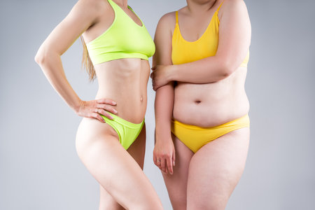 Before after weight loss, tummy tuck, fat and thin women with flabby and muscular bellies on gray studio background, plastic surgery and body positive conceptの写真素材