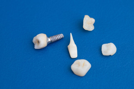 macro photo of a dental implant, dental crowns on a blue background. The work of a dental technician
