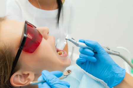 close-up medical dentist procedure of teeth polishing with cleaning from dental deposit and odontolithの写真素材