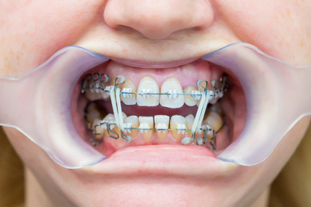 Closeup of woman's teeth with braces and retractor for mouth. Patient at the dentist - orthodontist. Orthodontic treatment using multiloop wire arches and elastic tractionの写真素材