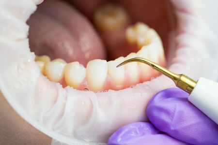Ultrasonic teeth cleaning, close-up. Removal of tartar, plaque. Paradontitis, paradantoz. Dentistry healthy teeth beautiful smileの写真素材