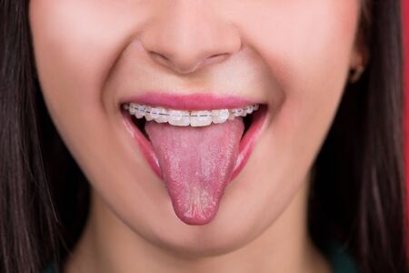 Braces. Beautiful Woman healthy smile close up. Closeup Ceramic Braces on Teeth. Beautiful Female Smile with Braces. Orthodontic Treatment.の写真素材