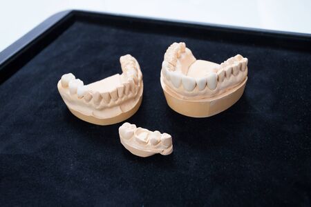 Ceramic teeth on a plaster model on a black background. Veneers, orthopedics, dentistryの写真素材