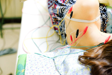 Asian girl Getting An Acupuncture Treatment