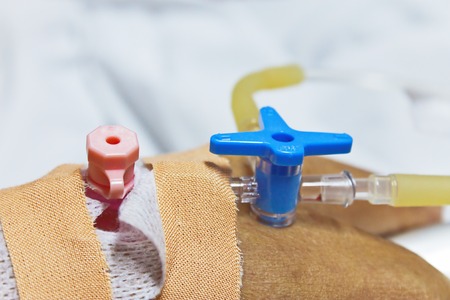 Two infusion pipe connected to blue infusion valve and pink injection inlet