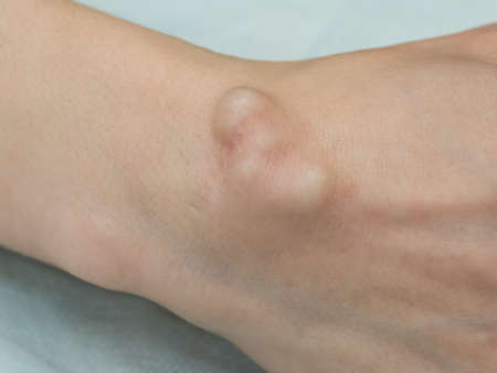 Big cyst hygroma, fluid filled lump associated with a joint, a tumor or swelling on top of a joint.