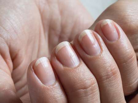 Damaged nails after gel polish. Close up