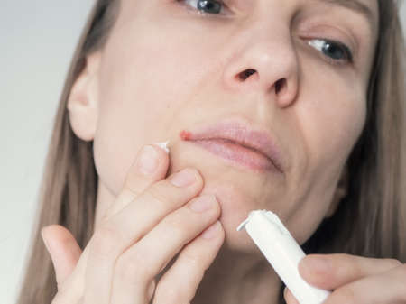 Woman's face with a virus herpes on lips, treatment with ointment, close up. herpes treatment. Recovery from illness in the spring.の写真素材