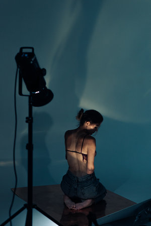 Beautiful young woman with amputee arm and scars from burn on her body poses in lacy bra. She...