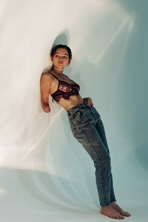 Young woman with amputee arm and scars from burn on her body poses in lacy bra. The concept of a...