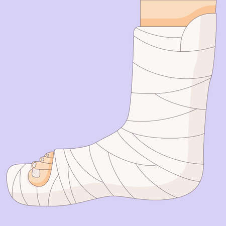Broken leg in a cast bandage, orthopedic gypsum, injury bone, vector illustration drawn in a flat style. Vector illustration.のイラスト素材
