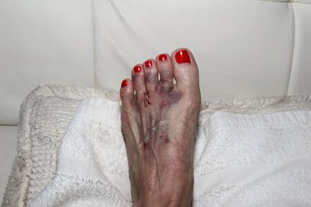 Foot after Mortons neuroma surgeryの写真素材
