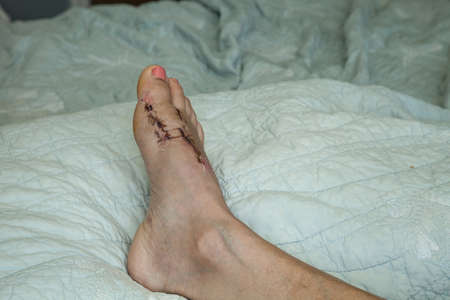 Stitches removed and foot elevated after bunion surgery on a bed.の写真素材