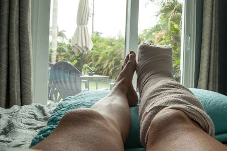 Foot in a cast after the first week of bunion foot surgery during recovery.の写真素材