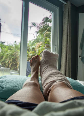Foot in a cast after the first week of bunion foot surgery during recovery.の写真素材