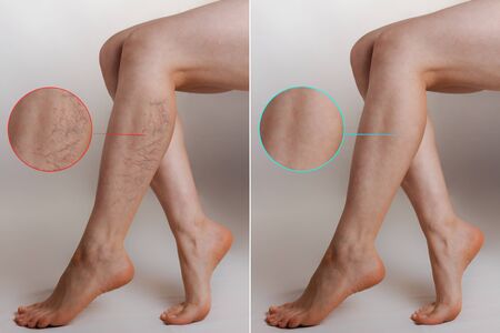 Medicine and health. The concept of female varicose veins. Female legs with vascular stars on the legs, with an enlarged picture. Before and after.の写真素材