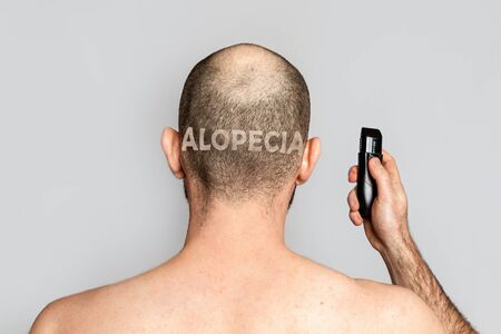 Male alopecia. A man with thinning hair is holding an electric razor. Rear view. Gray background. The inscription alopecia is shaved on the back of the head.の写真素材