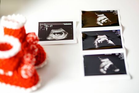 Booties and an ultrasound image on a white background, close-up. Concept of family planning and...