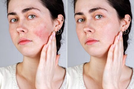Portrait of a young caucasian woman with red and inflamed blood vessels on her cheeks and without them after treatment. Close up. Gray background. The concept of couperose and rosacea. Before and after.の写真素材