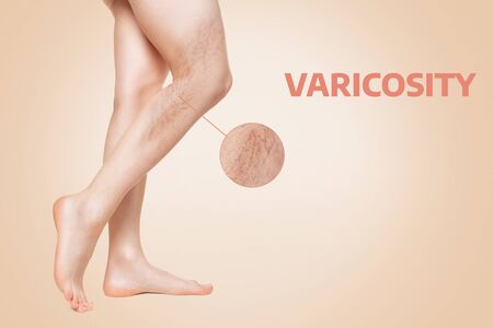 Varicosity. Smooth female legs, shown in profile, show varicose veins. Enlarged image of vessels in a circle. Beige background. The concept of varicose disease.の写真素材