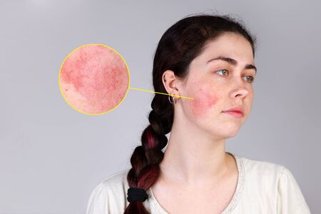 The concept of rosacea. A young Caucasian woman shows off a red cheek from rosacea. Copy space. The enlarged circle shows the problems with the skin. Gray background.の写真素材