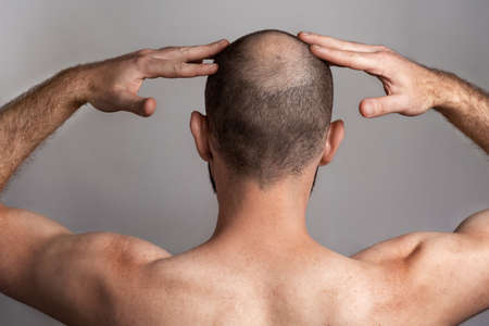 The concept of male alopecia and hair loss. Rear view, a man holding his hands over his head with a bald spot.の写真素材