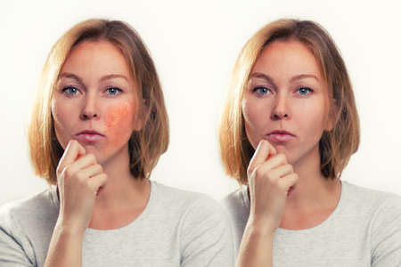 Medicine, cosmetology, rosacea. Blonde with rosacea-inflamed cheeks and blood vessels. Before and after.の写真素材