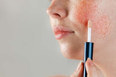 Medicine and cosmetology. Female cheek with rosacea close-up, with cosmetic Foundation on a brush near the skin. Copy space.の写真素材
