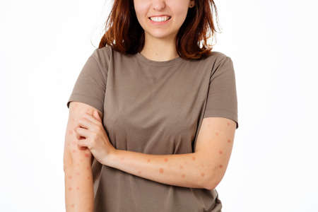 A young woman is nervously scratching her hands for rashes and redness. White background. Close up. The concept of scabies and allergies.の写真素材