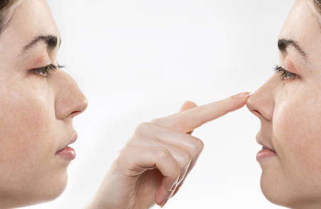 Rhinoplasty. Two female faces close-up showing the result before and after rhinoplasty. The index...