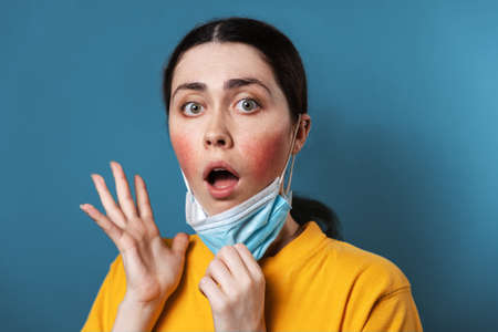 Maskne. Portrait of a young amazed woman shows irritation on her cheeks from wearing a protective...