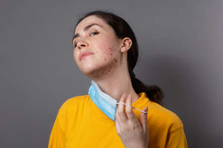Maskne. A young Caucasian woman takes off her protective mask and shows pimples on her chin. Gray...