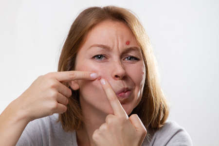 Medicine and cosmetology, acne. Portrait of a young blonde woman with pimples on her face, squeezes...