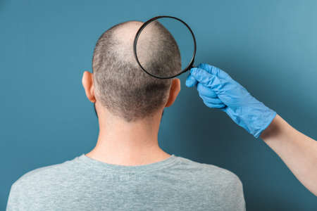 A man with alopecia on his head is being examined by a trichologist. The doctor's hand holds a magnifying glass at the center of baldness. Back view. Turquoise background. The concept of baldness and alopecia.の写真素材