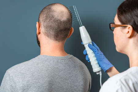 A man with baldness on his head during the procedure with the Darsonval device at the trichologist. Rear view. Turquoise background. The concept of alopecia and professional treatment.の写真素材