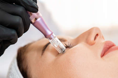 Professional skin care. Beauty treatment of fractional mesotherapy of woman's cheekbone. Close up of...